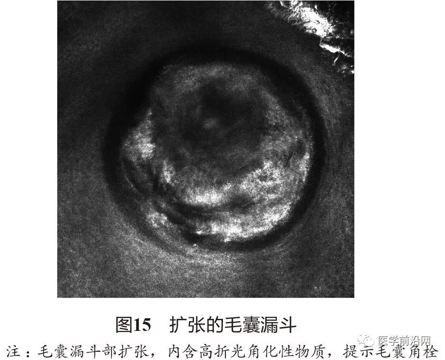 炎症性皮肤病反射式共聚焦显微镜诊断特征专家共识全文发布