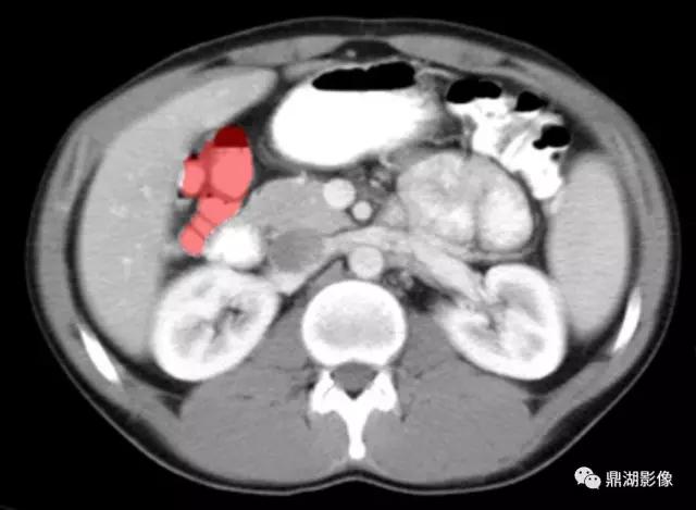 颈部胸锁乳突肌ct断层解剖图,骨盆骨质正常断层ct解剖图解