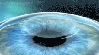 飞秒激光近视手术怎么更便宜,全飞秒近视激光手术价格有优惠吗