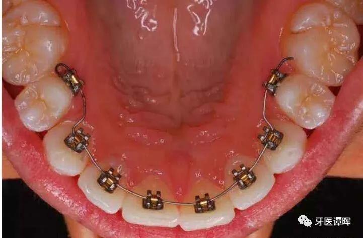 超详细的牙齿矫正过程,重叠牙齿矫正变化过程