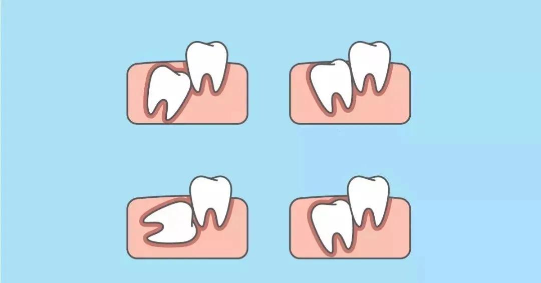 女子智齿烂脸,智齿发炎的真实案例