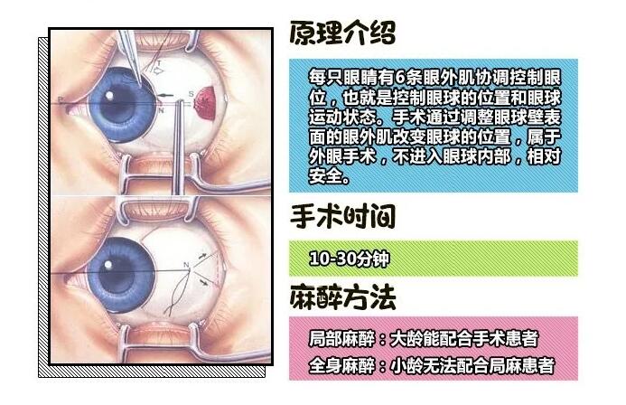 小孩眼睛斜视能不能矫正过来,宝宝眼睛斜视治疗费用