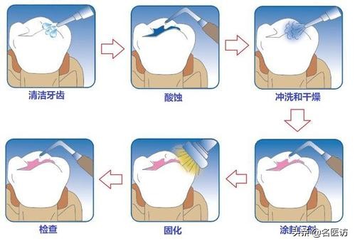 3-6岁儿童警报声,为什么六龄牙容易龋坏