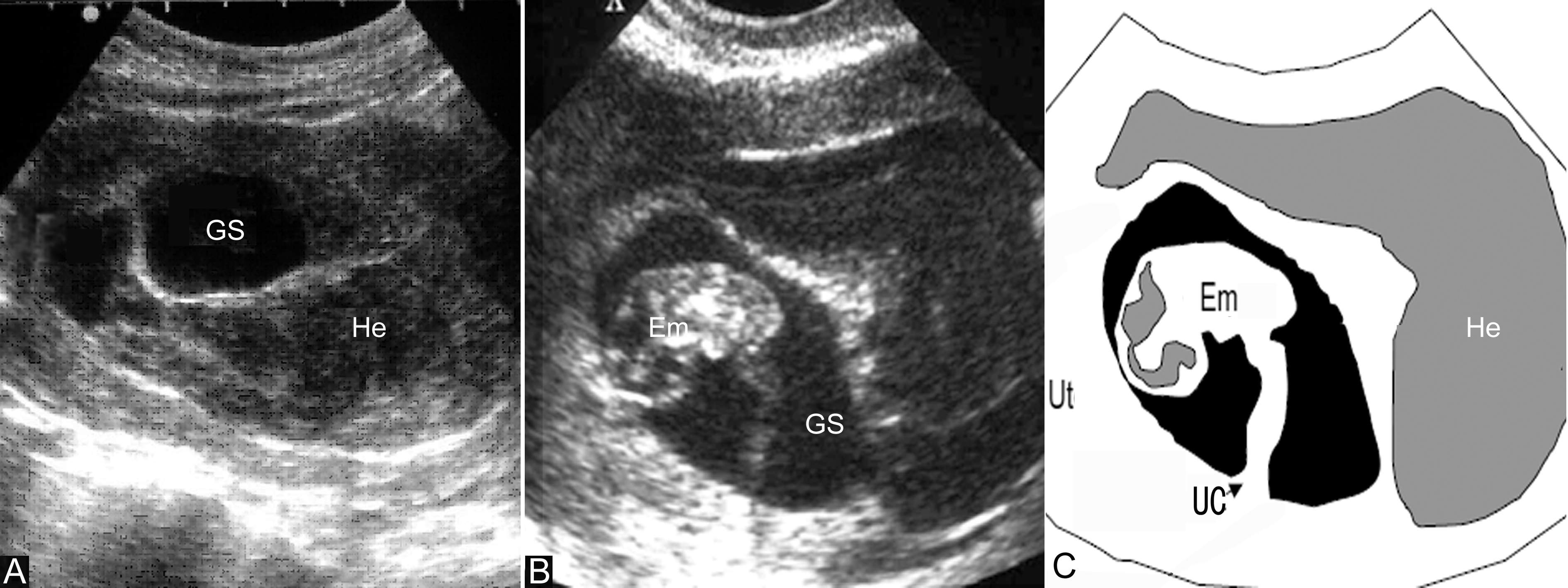 明明白白做超声32-3:流产:超声检查