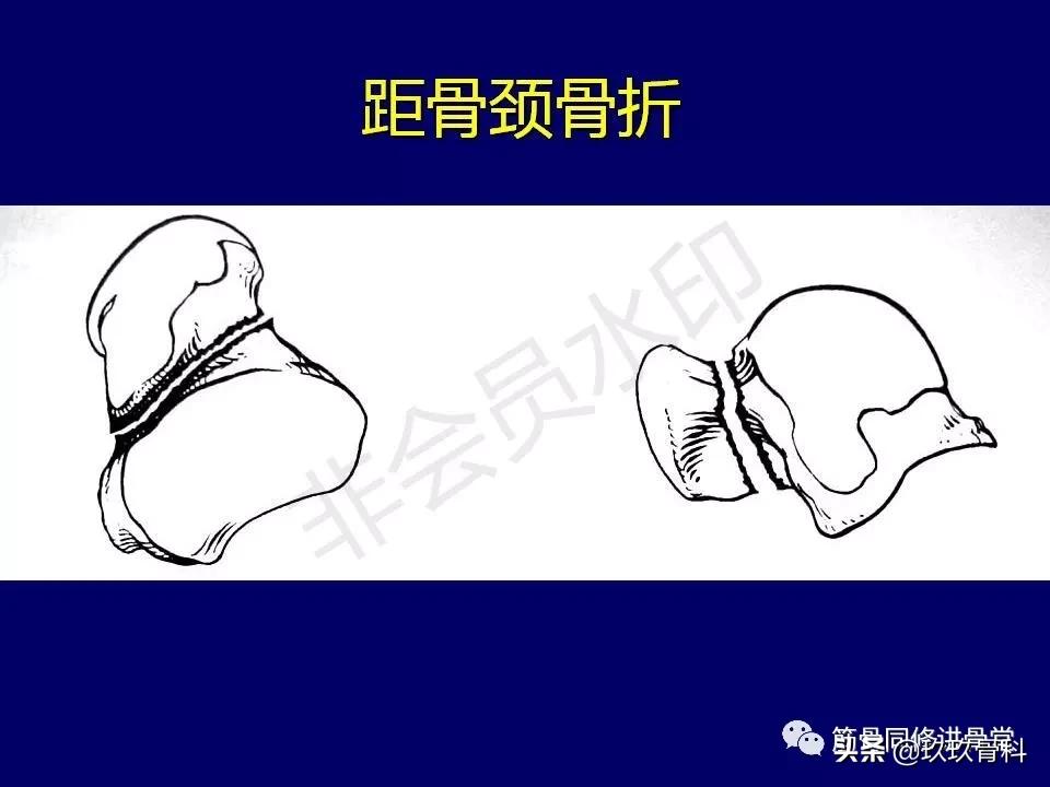 距骨骨折的治疗原则,距骨骨折如何调理