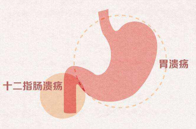胃下垂十二指肠淤滞,治疗胃十二指肠溃疡的最佳穴位