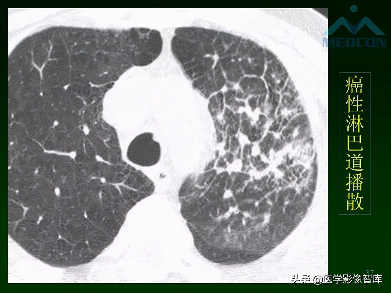 肺弥漫性网状影,两肺小叶间隔增厚可见网状模糊影