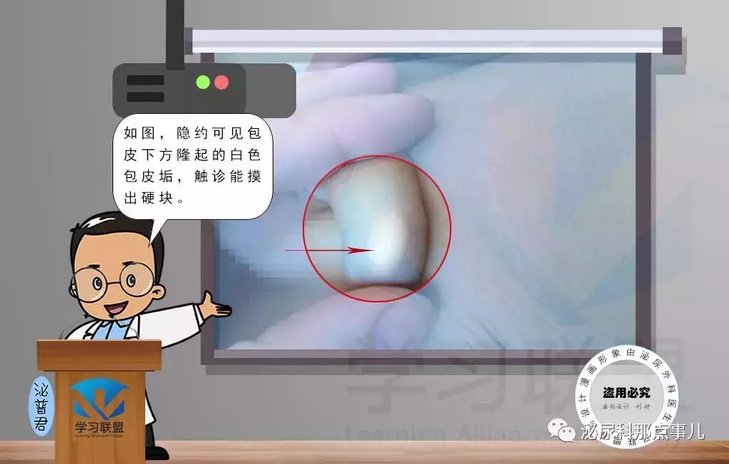 「科普」丁丁皮下有了硬块是怎么回事？