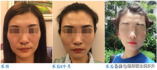 脸部皮肤松弛怎么改善医美,脸部皮肤松弛怎么处理