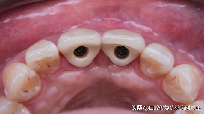展评优秀病例赏析|Asc全瓷角度基台一体冠进行种植前牙美学修复