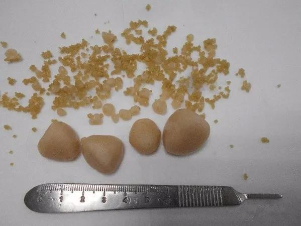 狗狗尿结石自己排出来了怎么办,狗狗尿结石恢复还有点漏尿怎么办