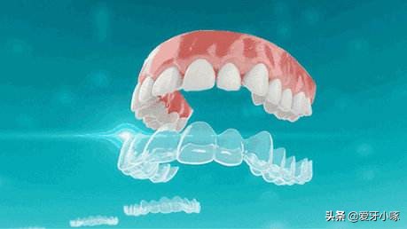 时代天使隐形矫正多少钱,时代天使隐形矫正收费标准