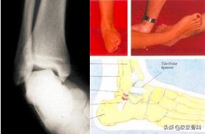 陈旧性踝关节损伤的治疗,踝关节损伤现场处理视频