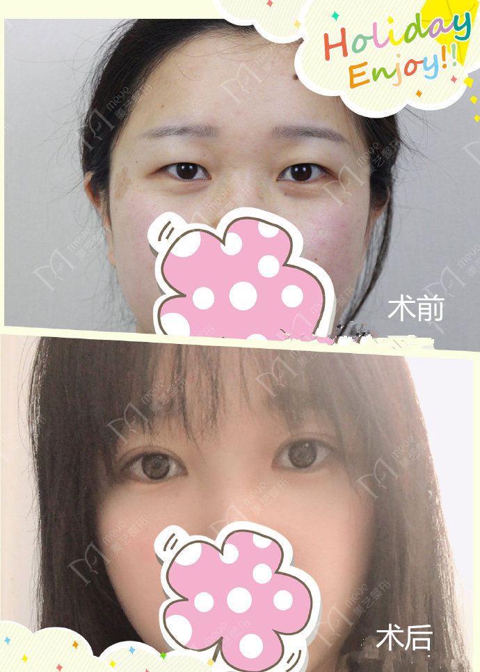 肿眼泡建议割双眼皮吗,肿眼泡做双眼皮怎样才会成功