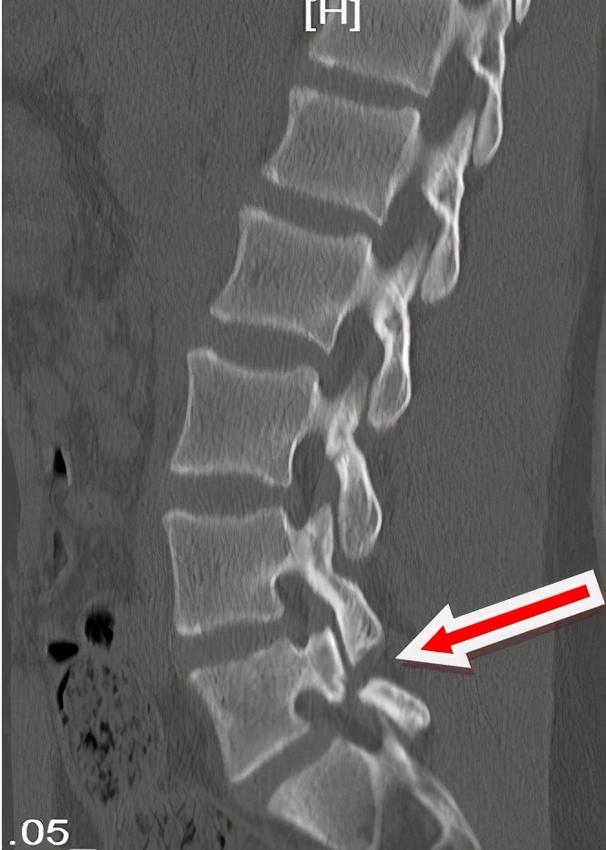腰椎峡部裂能贴膏药吗,腰椎峡部裂是什么意思