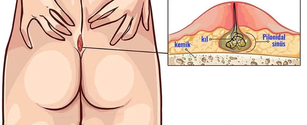 屁屁中间毛太多，也可能是病吗？