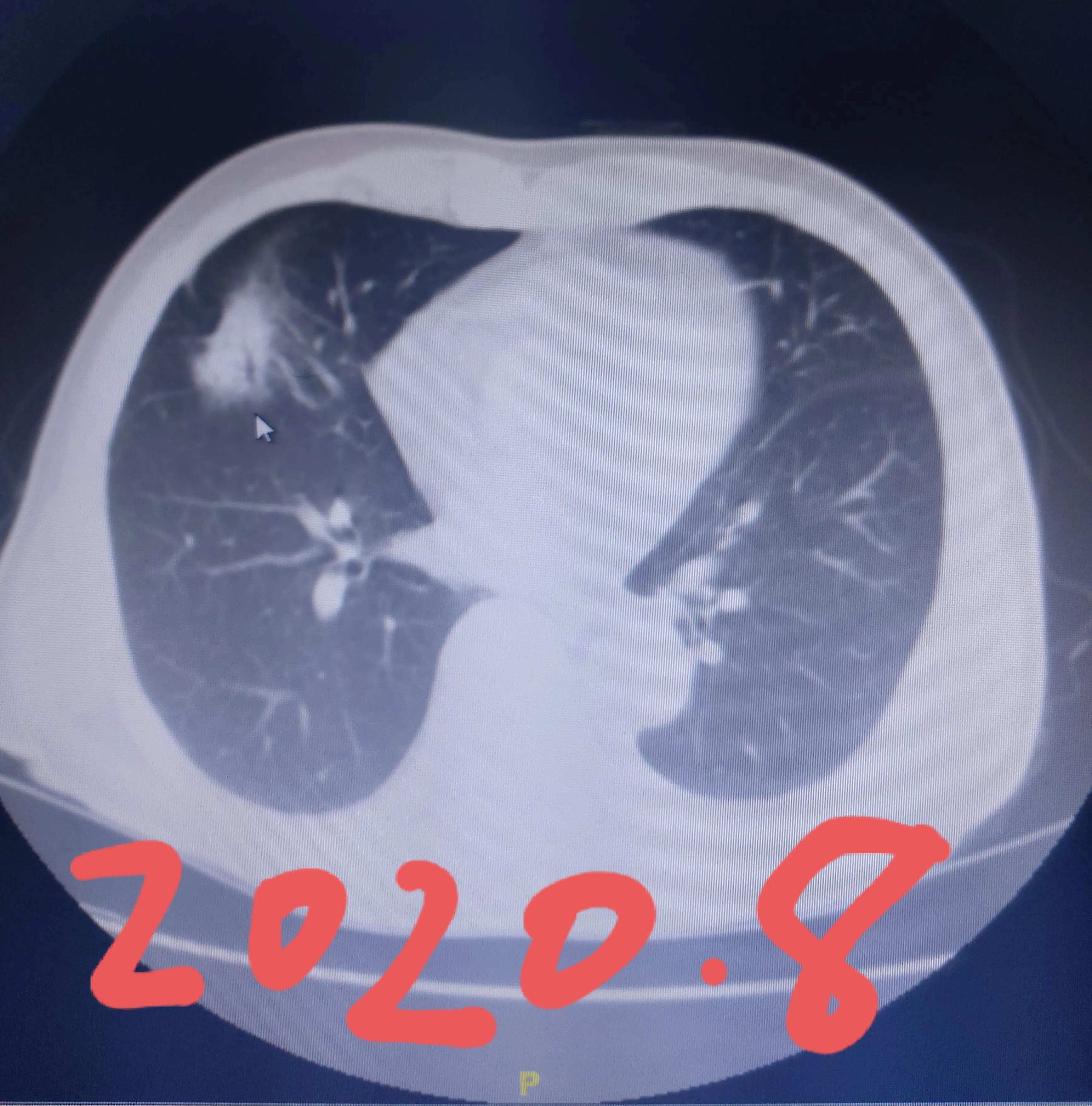 刘懿讲肺结节术前谈话,刘懿博士说小细胞肺癌