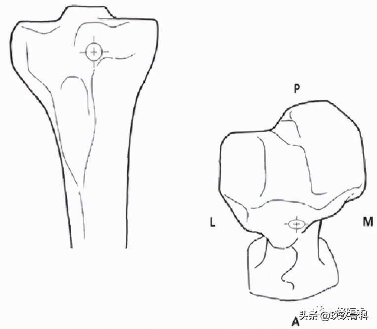 髓内钉技巧,髓内钉教学视频讲解