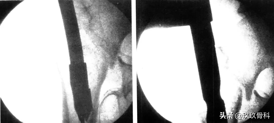 骨科取髓内钉的视频,骨科髓内钉内固定术式简写