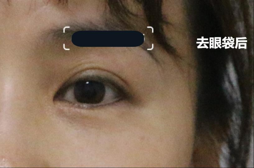 内切眼袋7天恢复全程记录,内切去眼袋恢复需要怎样做