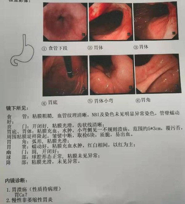 胃癌术后辅助化疗一次多少钱,可切除胃癌新辅助化疗首选方案