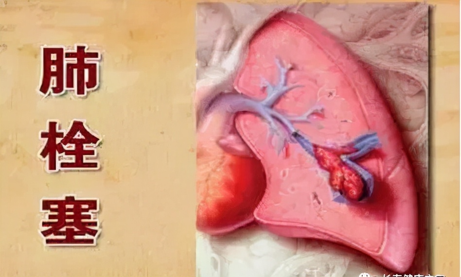 孕期血栓栓塞如何预防,孕妇需知揭秘产科杀手羊水栓塞