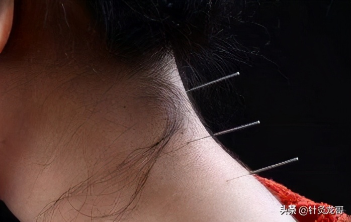 针灸一定要补或者泻吗,针灸扎到穴位通过什么可以治病