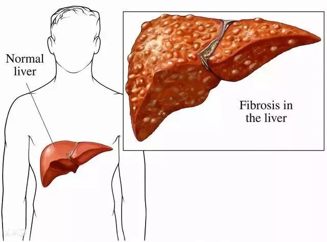 肝硬化抗病毒治疗能逆转脾亢吗,肝硬化了抗病毒还有用吗