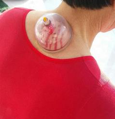 刺血拔罐疗法教学视频,拔罐疗法治疗