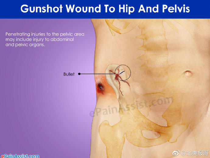 人体一旦被子弹击中后会怎样,被麻醉弹击中会怎样
