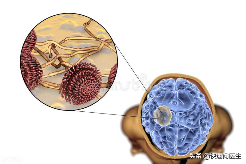 小腹胀痛白带发黄是什么妇科病,女人白带发黄警惕这3种妇科病