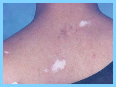 白斑和白癜风区别症状,白斑和白癜风有什么区别