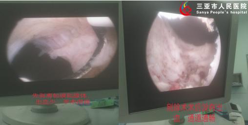 用技术挽留夕阳之美——三亚市人民医院泌尿外科成功为93岁高龄老人实施经尿道等离子前列腺剜除术