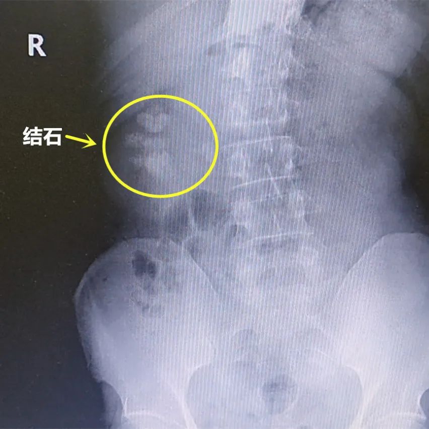 泌尿系结石的中西医最新治疗,泌尿系统结石的难点