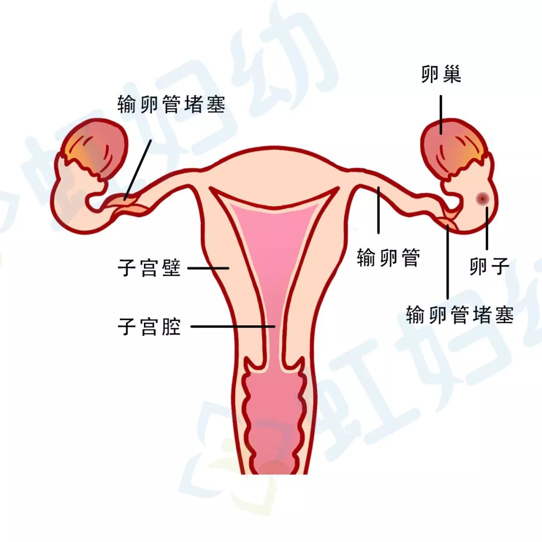 人流导致不孕可以做试管吗,人流后女性如何预防不孕