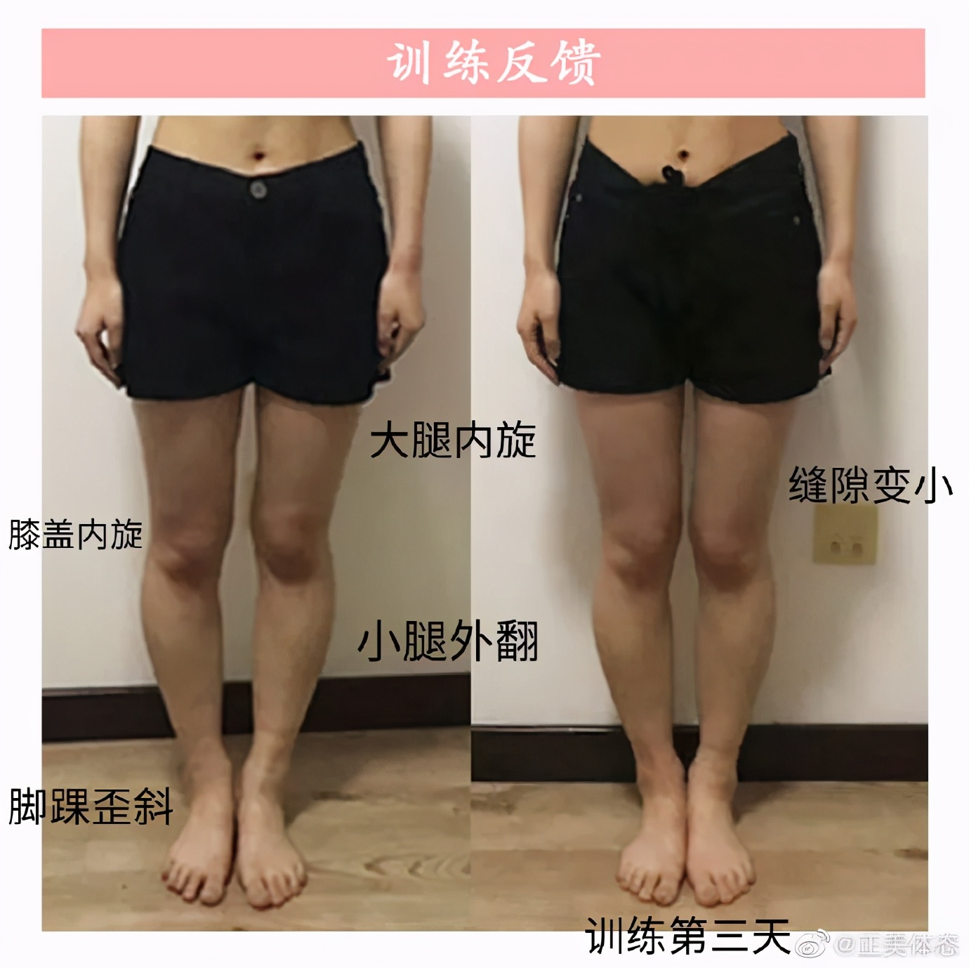 小腿外翻如何把腿练直,小腿外翻腿不直怎么矫正训练
