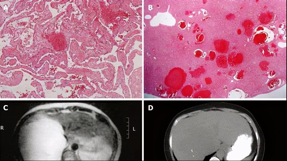 为什么肝血管瘤医生建议不用管,有了肝血管瘤要注意什么