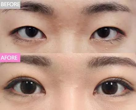 不建议做双眼皮的三种情况,为什么不建议做双眼皮