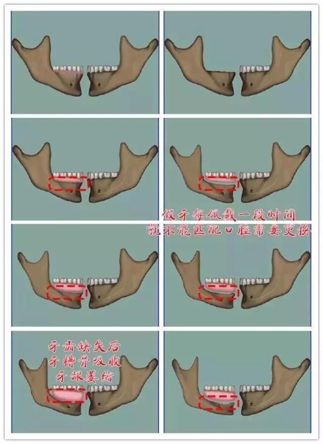 缺牙真的伤不起,缺牙对你最大的影响