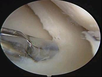 半月板像肉筋还是板筋,半月板最容易损伤的瞬间