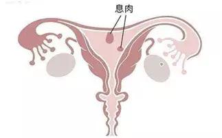 梁雪芳：怕它不来，又怕它乱来！异常子宫出血怎么办？