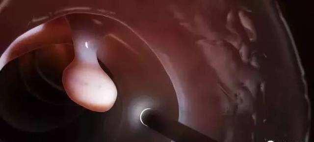 “肛”湖问道|肠治久安，息肉早切除