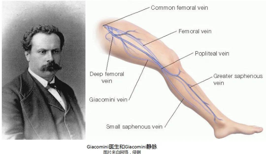 chiva治疗下肢静脉曲张价格,chiva治疗静脉曲张