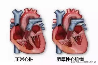 吉林男子突发心脏病,40岁男子跑步10年马拉松患心脏病