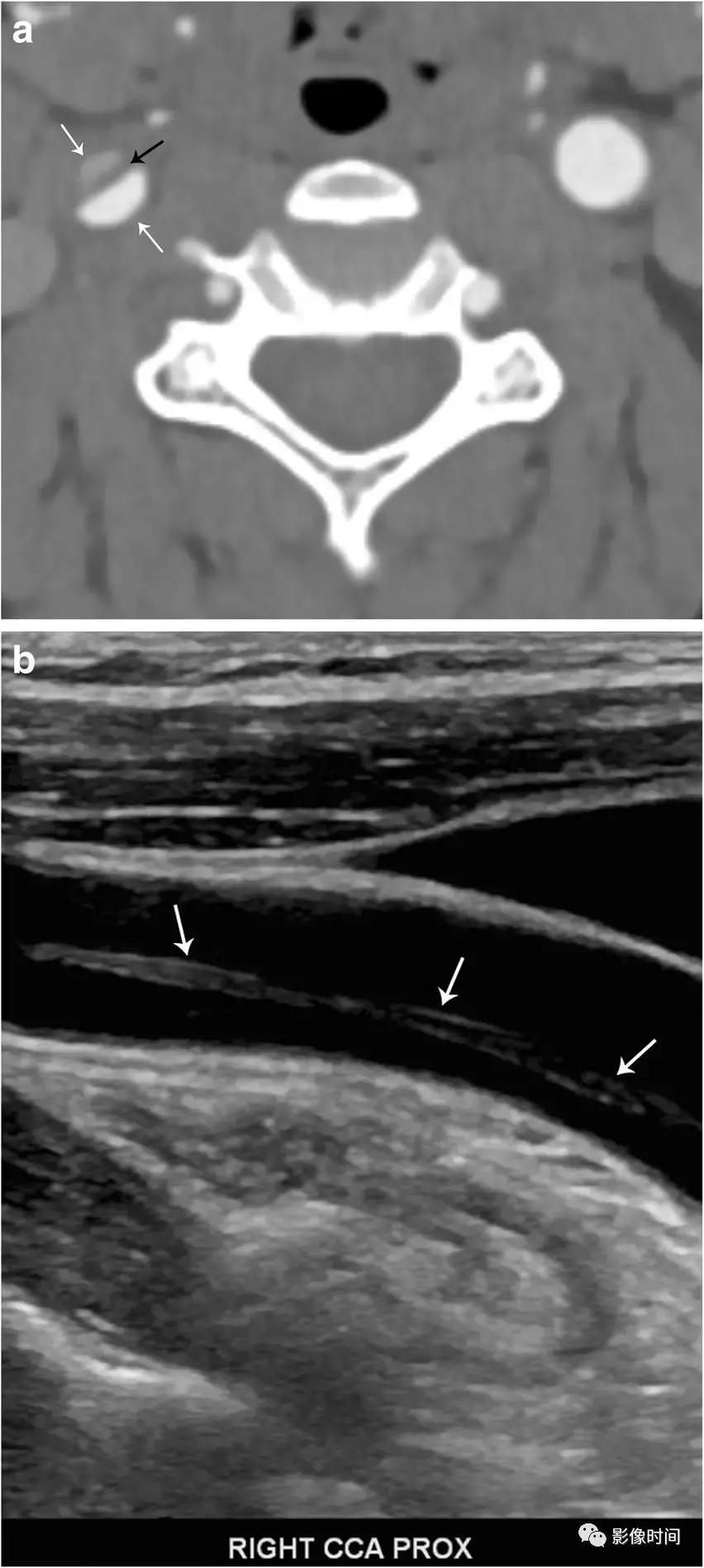 双侧颈动脉鞘间隙多发小淋巴结影,双侧颈动脉间隙多软组织密度结节
