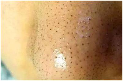 去黑头粉刺最有效的解决方法,如何正确的去黑头粉刺