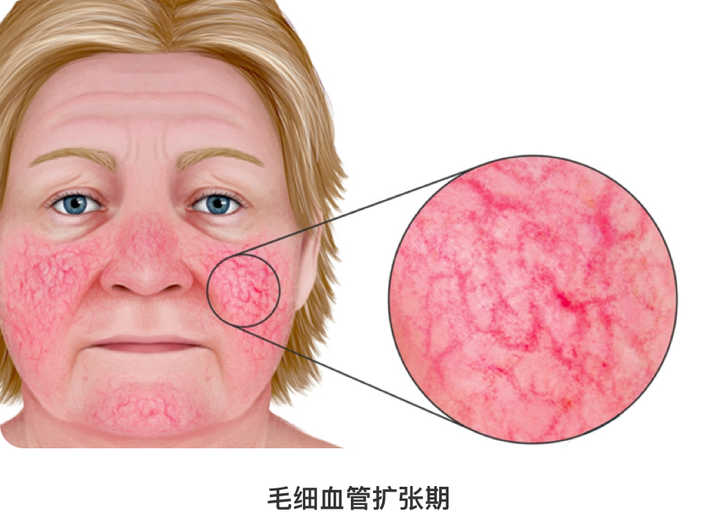 疮疤性痤疮,丘疹型玫瑰疮怎么治