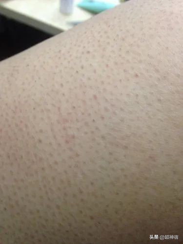 比痘痘更烦人的闭口来了，最有效的去闭口*法大**看过来