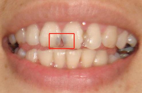 门牙牙缝开始发黑怎么挽救,门牙牙根黑了该怎么补救