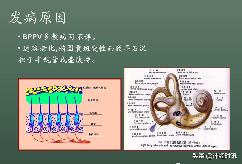 良性位置性眩晕诊断和治疗指南,良性阵发性位置性眩晕的诊断标准
